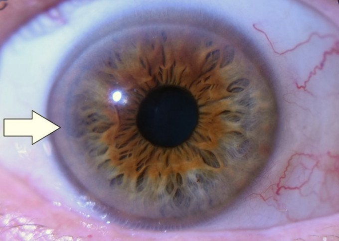 Diagnostika z dúhovky oka