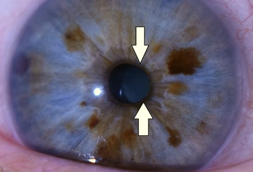 Irisdiagnostika z oka - zornička