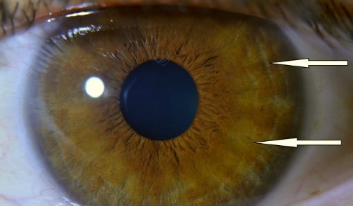 Diagnostika z oka, tygrie oči 
