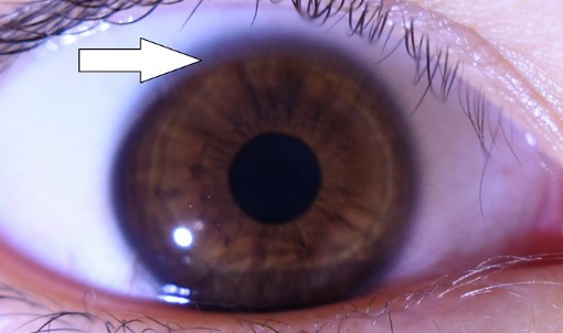Dignostika z očnej zreničky